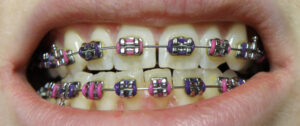 Dental Braces: Everything You Need to Know Before Getting Them